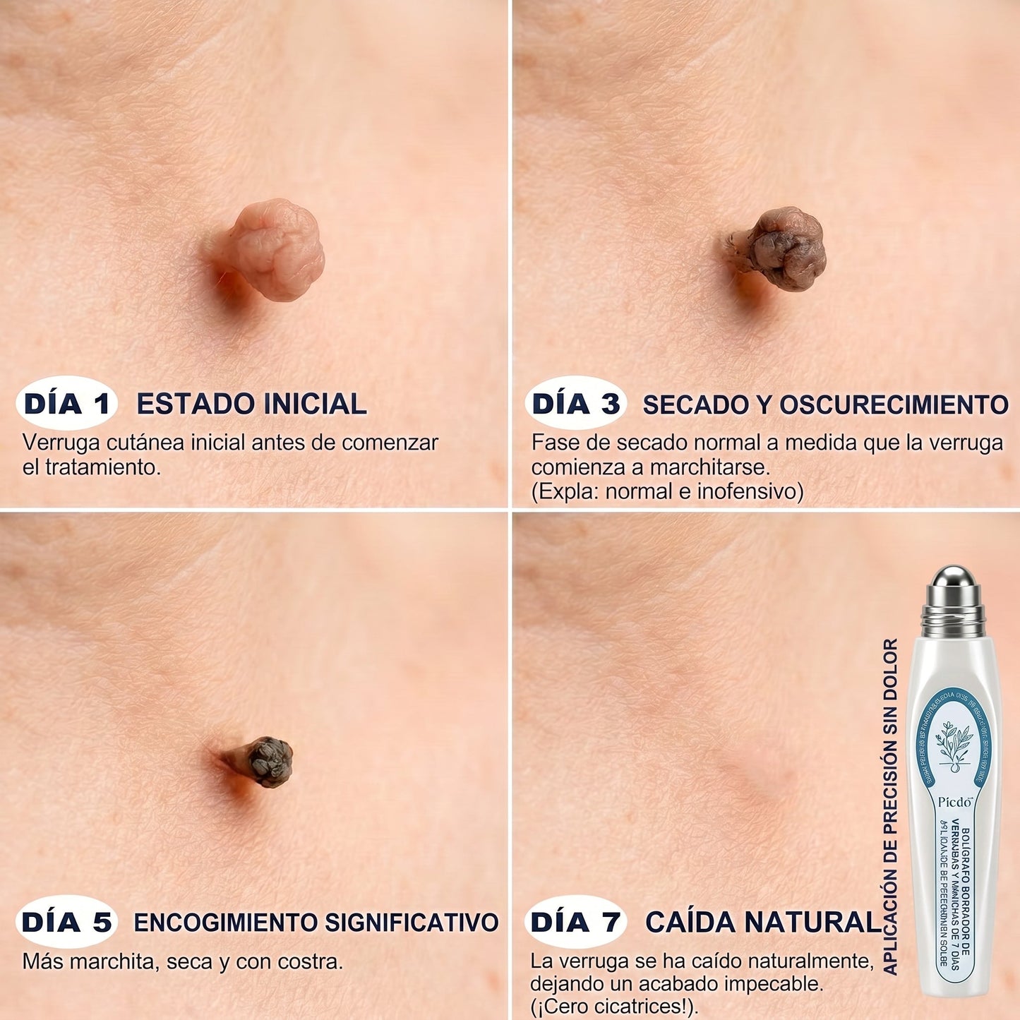𝐏𝐢𝐜𝐝𝐨® Borrador de Verrugas y Manchas en 7 Días (𝐀𝐩𝐥𝐢𝐜𝐚𝐝𝐨𝐫 𝐫𝐨𝐥𝐥-𝐨𝐧: 𝐬𝐢𝐧 𝐝𝐨𝐥𝐨𝐫 𝐧𝐢 𝐜𝐢𝐜𝐚𝐭𝐫𝐢𝐜𝐞𝐬)