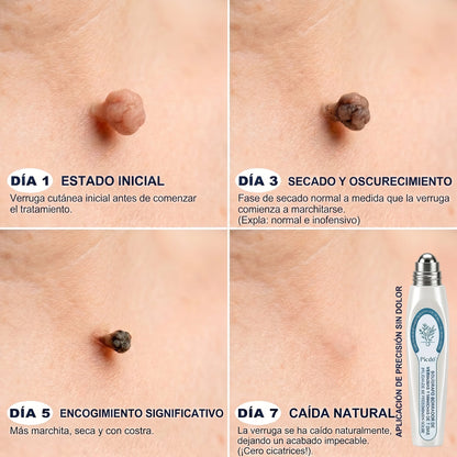 𝐏𝐢𝐜𝐝𝐨® Borrador de Verrugas y Manchas en 7 Días (𝐀𝐩𝐥𝐢𝐜𝐚𝐝𝐨𝐫 𝐫𝐨𝐥𝐥-𝐨𝐧: 𝐬𝐢𝐧 𝐝𝐨𝐥𝐨𝐫 𝐧𝐢 𝐜𝐢𝐜𝐚𝐭𝐫𝐢𝐜𝐞𝐬)