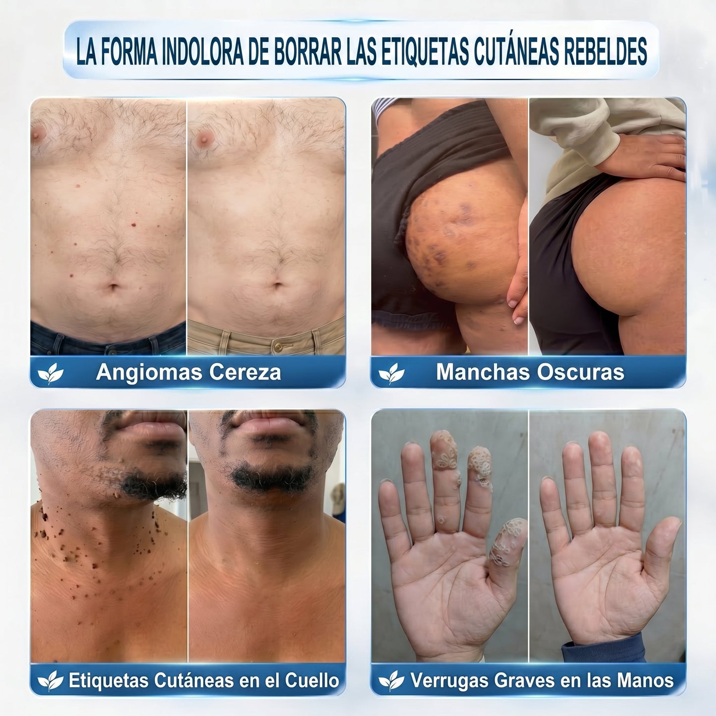 𝐏𝐢𝐜𝐝𝐨® Borrador de Verrugas y Manchas en 7 Días (𝐀𝐩𝐥𝐢𝐜𝐚𝐝𝐨𝐫 𝐫𝐨𝐥𝐥-𝐨𝐧: 𝐬𝐢𝐧 𝐝𝐨𝐥𝐨𝐫 𝐧𝐢 𝐜𝐢𝐜𝐚𝐭𝐫𝐢𝐜𝐞𝐬)