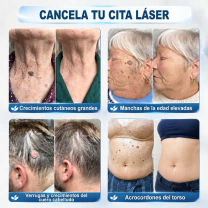 𝐏𝐢𝐜𝐝𝐨® Borrador de Verrugas y Manchas en 7 Días (𝐀𝐩𝐥𝐢𝐜𝐚𝐝𝐨𝐫 𝐫𝐨𝐥𝐥-𝐨𝐧: 𝐬𝐢𝐧 𝐝𝐨𝐥𝐨𝐫 𝐧𝐢 𝐜𝐢𝐜𝐚𝐭𝐫𝐢𝐜𝐞𝐬)